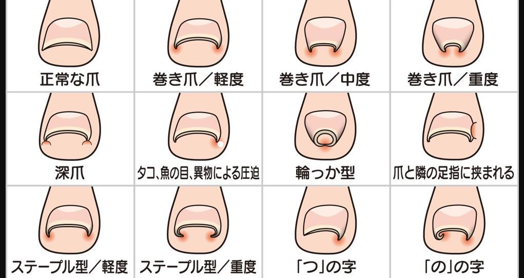 【Wiki風】 爪 に 現れる 病気 の サイン インスタライブ最新動画 #748